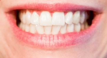 Các cách làm trắng răng tại nha khoa bạn nên biết