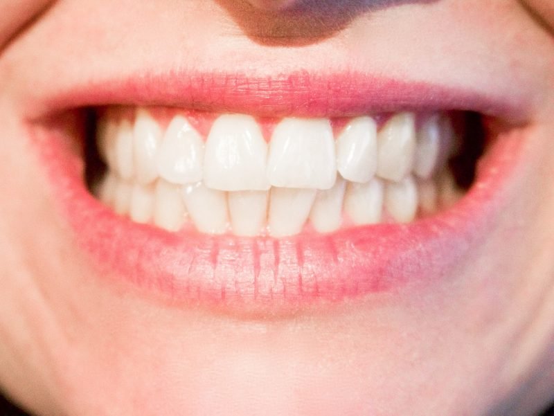 Các cách làm trắng răng tại nha khoa bạn nên biết
