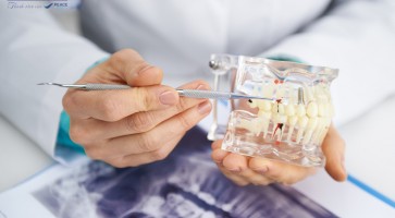 Chi phí trồng răng cấm theo từng phương pháp hiện nay